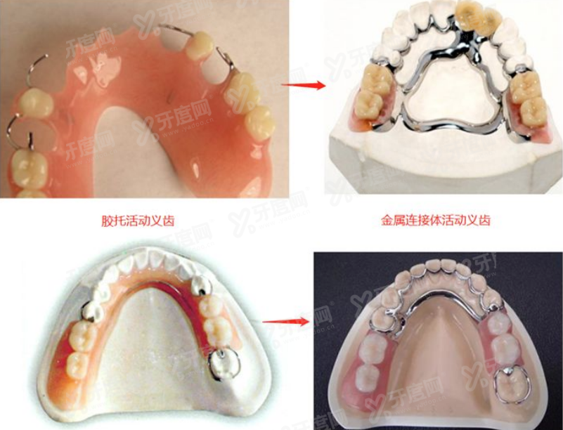 镶牙和补牙有什么区别.jpg