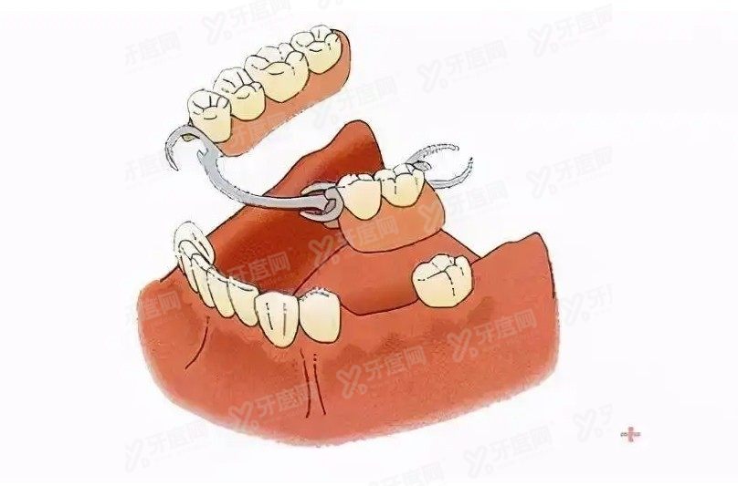 牙齿掉了是镶牙好还是种牙好？www.yadoo.cn