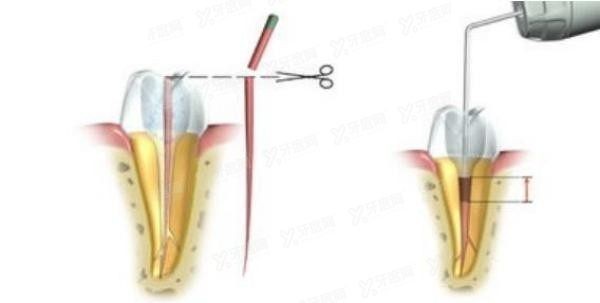 根管治疗的具体流程是什么?全部过程可分为开髓|清洁等四个步骤!.jpg.www.yadoo.cn