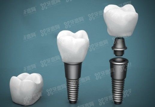 2024杭州口腔医院种植牙价格表www.yadoo.cn