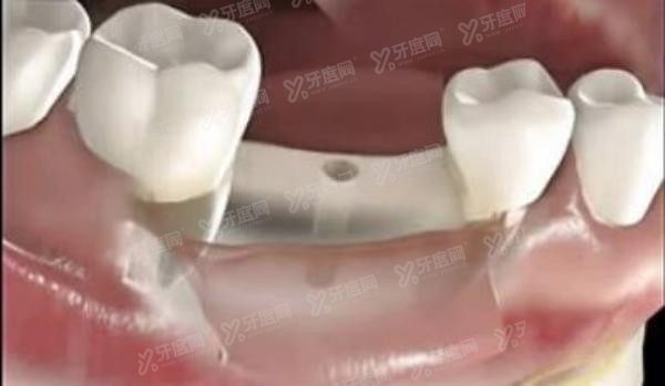 穿颧穿翼种植是什么.jpg