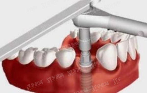 穿颧穿翼种植是什么？穿颧穿翼种植技术及适应症详解!.jpg