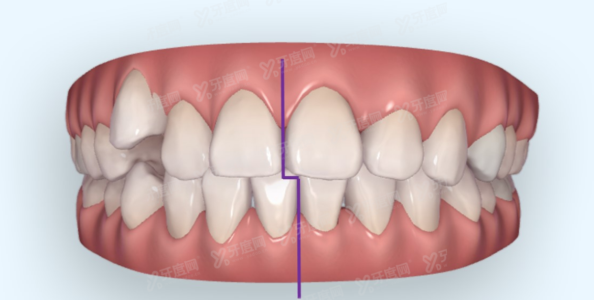 牙中线不齐导致脸歪怎么办.jpg