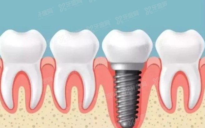 张家港皓康口腔医院种植牙一颗多少钱
