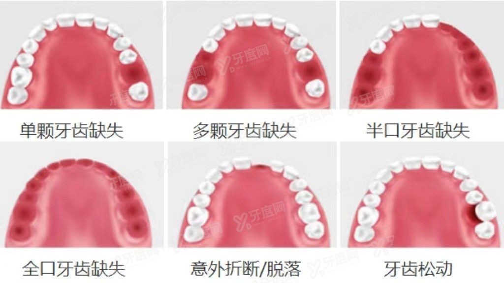 福清德恒口腔种植牙补贴多少钱.jpg