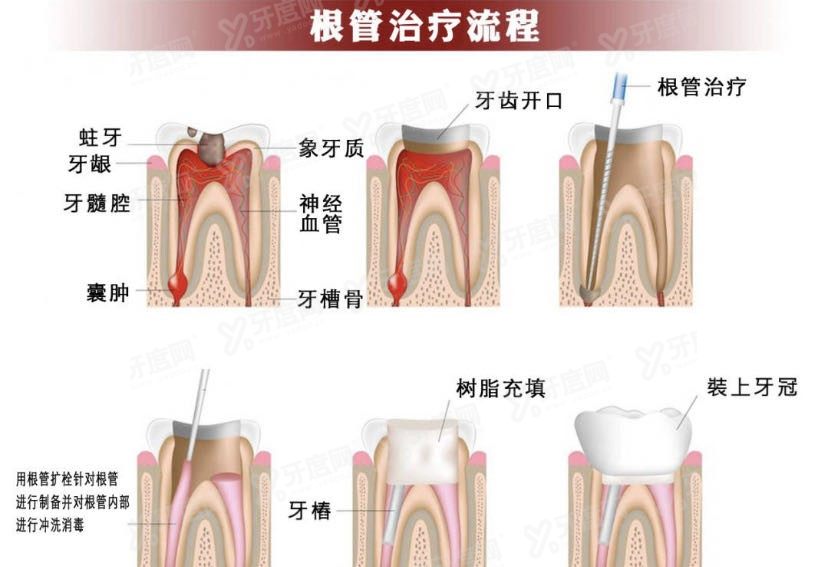 为什么良心医生不建议做根管治疗.jpg