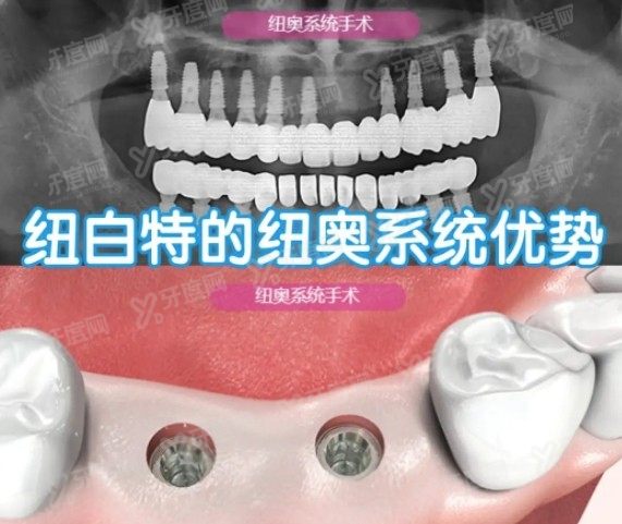 韩国纽百特种植体怎么样？www.yadoo.cn