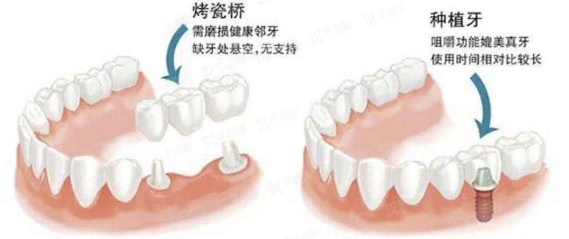 烤瓷牙和种植牙怎么选择?从修复过程看.jpg