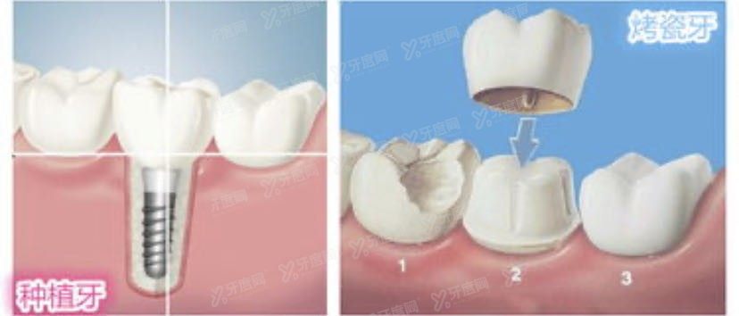 烤瓷牙和种植牙怎么选择?从优劣势看.jpg