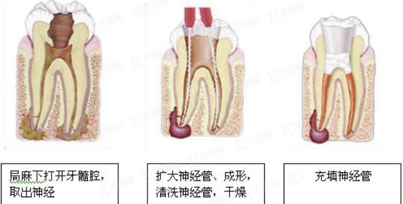 根管治疗步骤怎么操作www.yadoo.cn.jpg