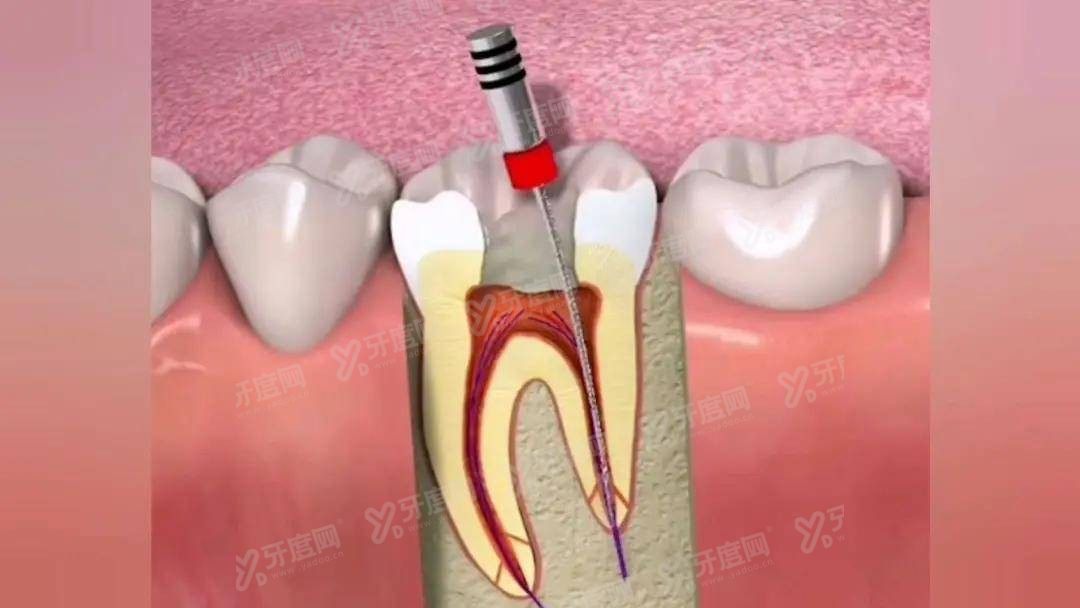 根管治疗有效