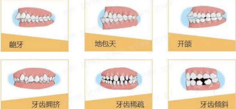 嘴里有假牙还能戴牙套吗.jpg