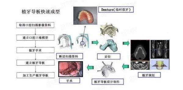 种植牙的流程和注意事项有哪些？种植牙的流程3——定制种植牙手术导板.jpg