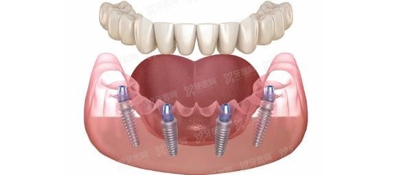 allon4和allon6区别:价格|适应症|使用寿命不同.jpg.www.yadoo.cn