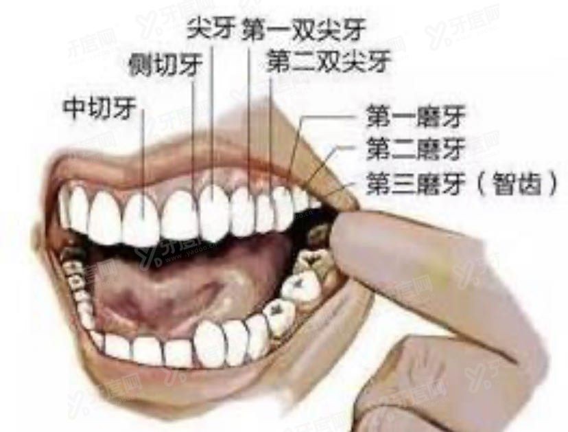 智齿反复发炎不去拔掉的后果www.yadoo.cn.jpg