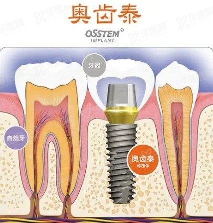 科威尔种植体和奥齿泰的稳定性哪个好www.yadoo.cn