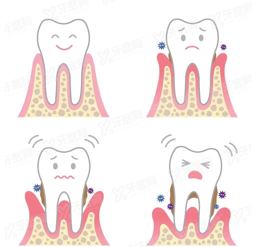 牙周炎的临床表现有哪些www.yadoo.cn