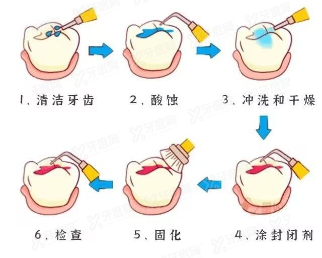 窝沟封闭是什么意思有必要做吗？www.yadoo.cn 