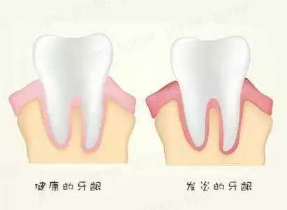 反复牙龈肿痛怎么办