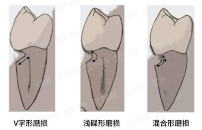 楔状缺损是什么原因引起的www.yadoo.cn