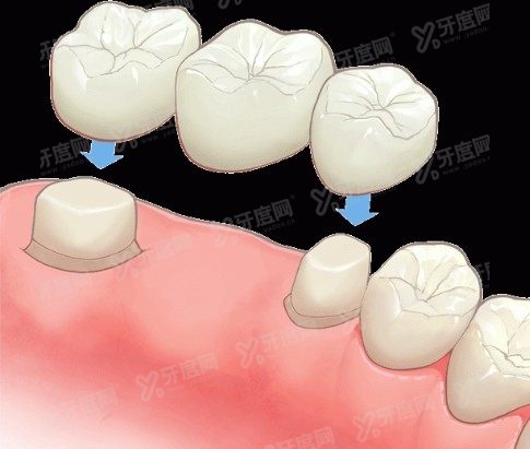 宜宾口腔医院镶牙多少钱www.yadoo.cn