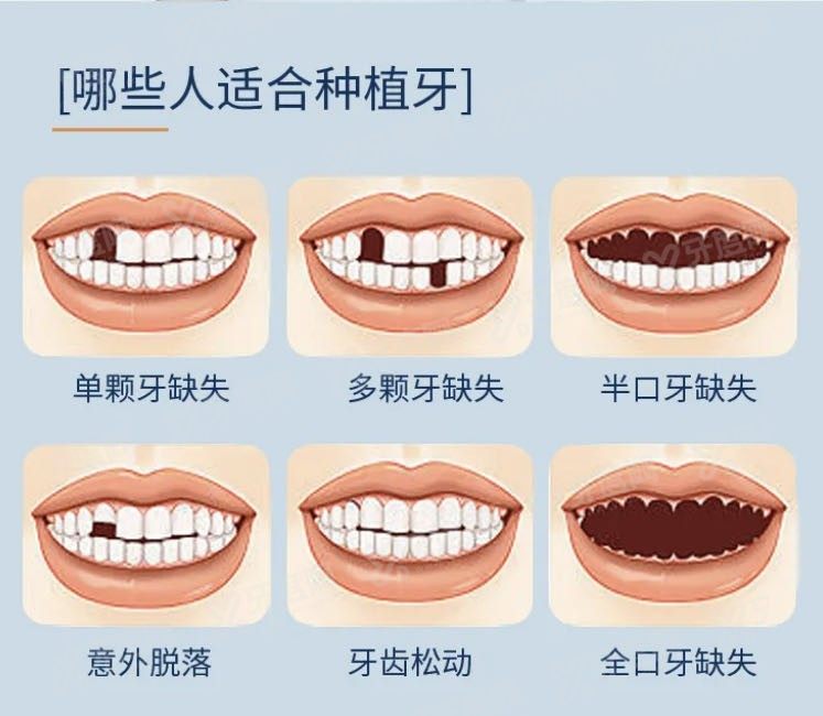 哈尔滨种植牙集采什么时候开始www.yadoo.cn.jpg