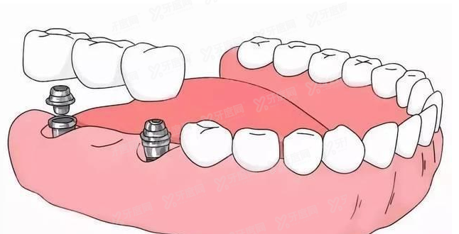 重庆齐美口腔医院种植牙价格表m.yadoo.cn