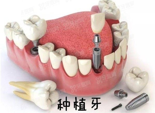麦芽口腔医院种植牙价格表www.yadoo.cn