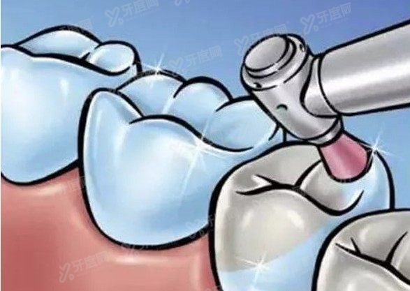 三甲口腔医院种植牙多少钱一颗2024www.yadoo.cn