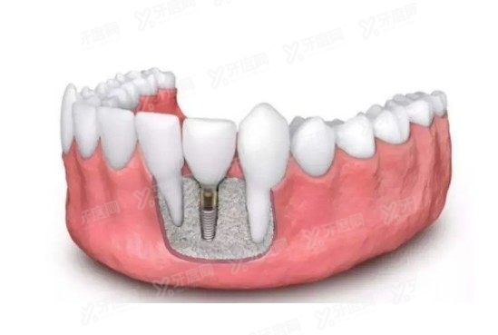 运城口腔医院种植牙价格表www.yadoo.cn