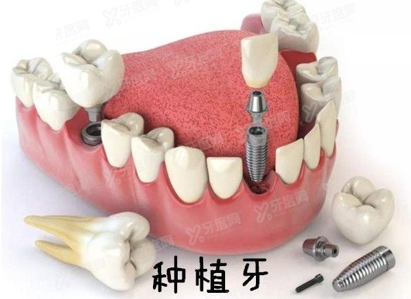 上海嘉定区口腔医院种植牙价格表www.yadoo.cn