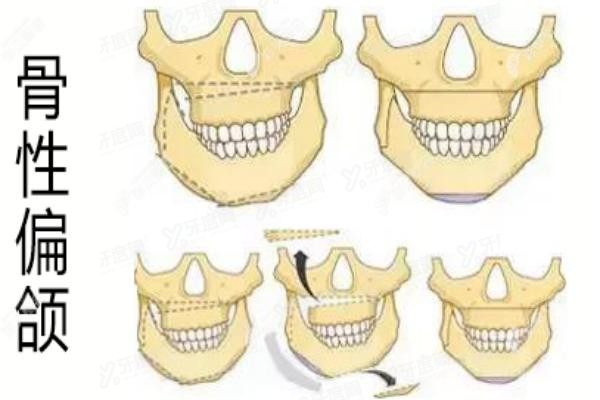 骨性偏颌一定要手术吗www.yadoo.cn