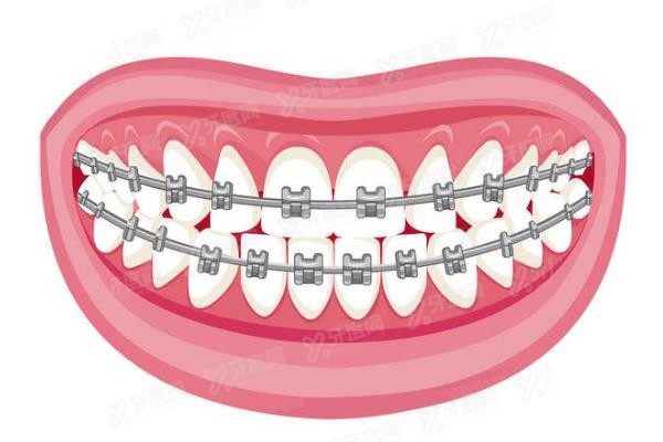 桂林牙齿矫正价格多少钱www.yadoo.cn