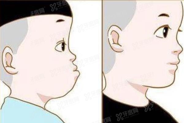 西安口腔医院正颌手术费用www.yadoo.cn