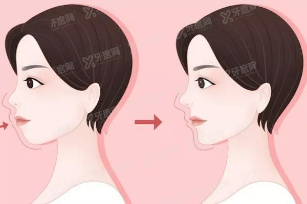 长沙正颌手术医院排名www.yadoo.cn