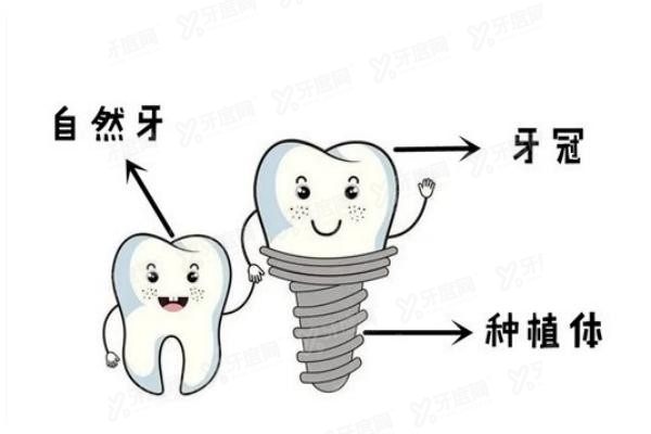 淮北口腔医院种植牙收费标准www.yadoo.cn20240531490497.jpg
