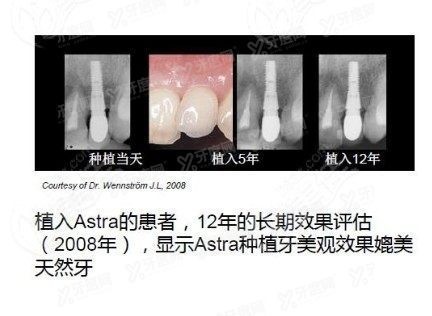 瑞典种植牙2023收费标准 www.yadoo.cn