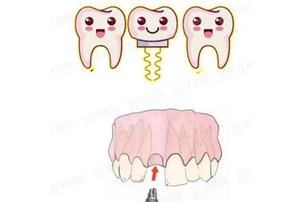 长沙开福区口腔医院种植牙价格表www.yadoo.cn