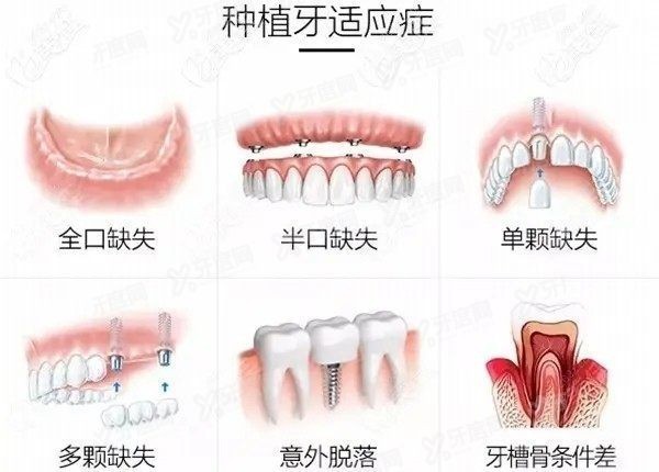 北京、上海、广州、深圳种植牙价格表2024