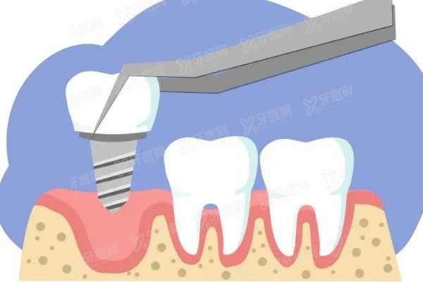 郴州口腔医院种植牙价格表www.yadoo.cn