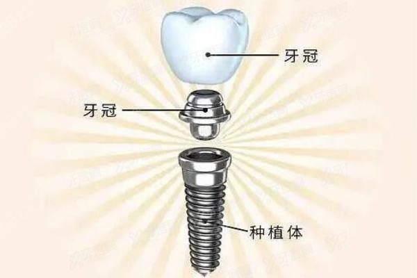 雅定种植牙2024价目表www.yadoo.cn20241115612741.jpg