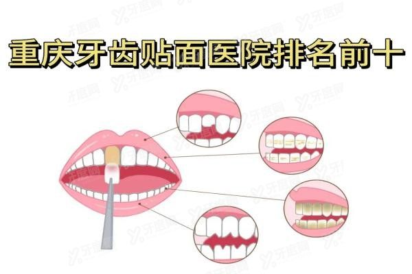 重庆牙齿贴面医院排名前十www.yadoo.cn