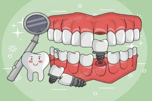 中喜口腔医院种植牙怎么样www.yadoo.cn
