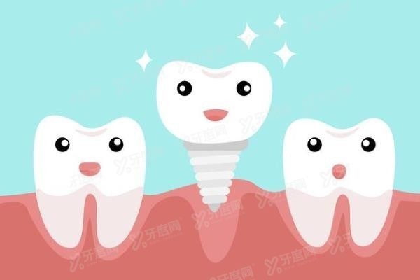 种植牙哪个品牌性价比高www.yadoo.cn