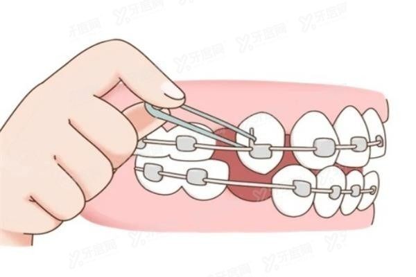 广州圣贝口腔医院牙齿矫正费用yadoo.cn