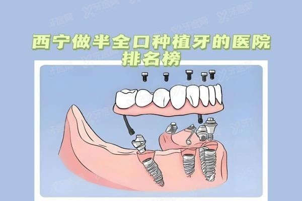 西宁做半全口种植牙的医院排名榜www.yadoo.cn