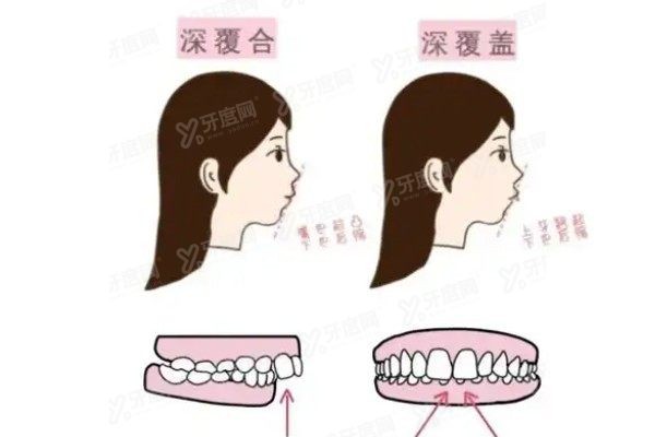 深覆合牙齿矫正费用大概多少钱www.yadoo.cn
