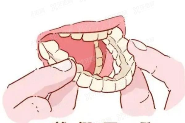 全口假牙固定不脱落方式有几种