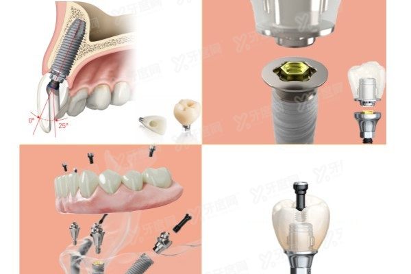 诺贝尔种植体哪个系列型号更好www.yadoo.cn