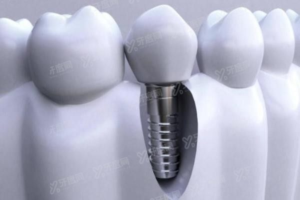 韩国诺泰种植体属于什么档次www.yadoo.cn20250306200091.jpg